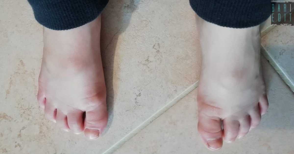 Infiammazioni nodulari ai piedi dei bambini, ricerca barese svela: �C'entra il Coronavirus�